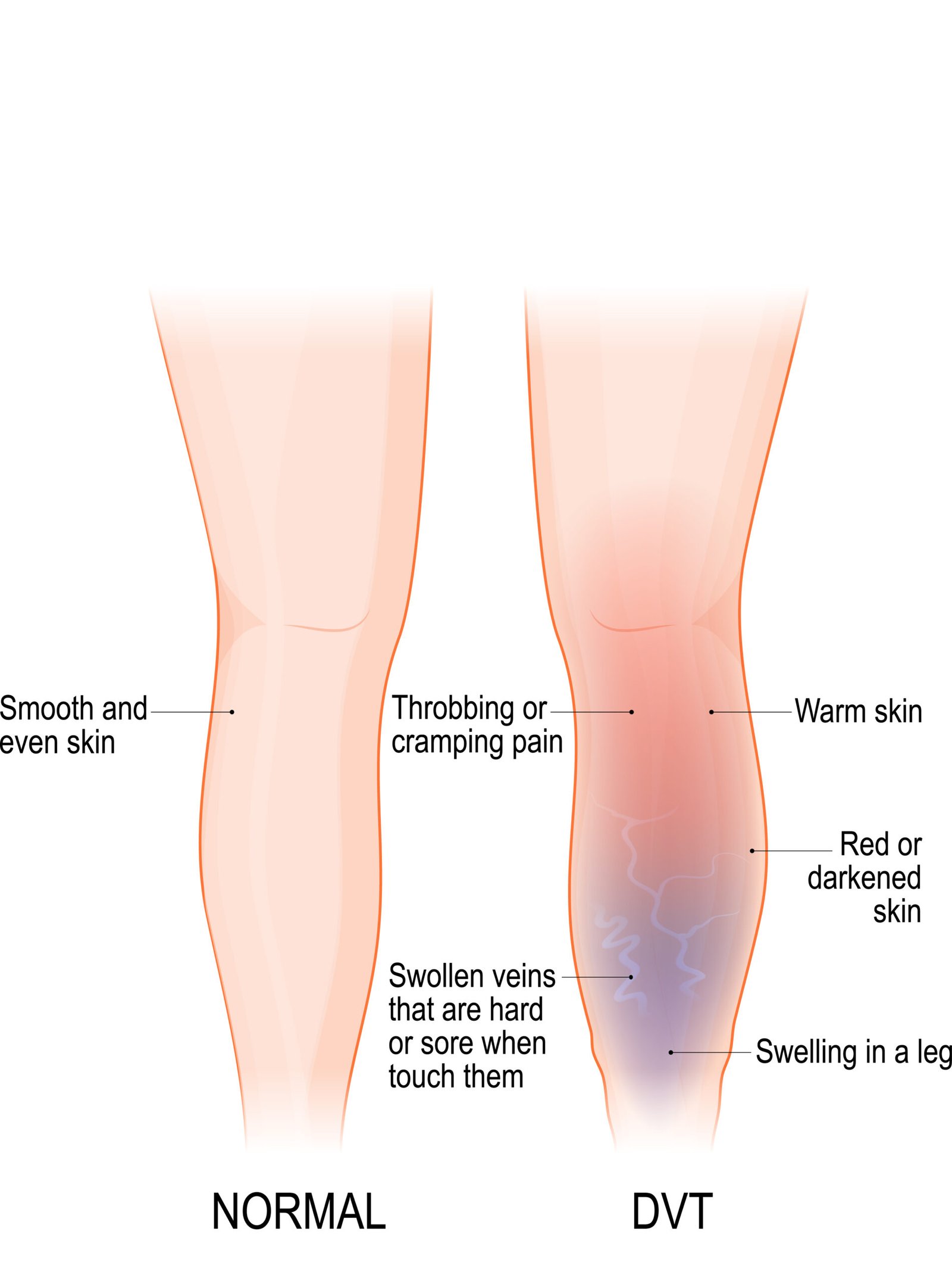 DVT symptoms