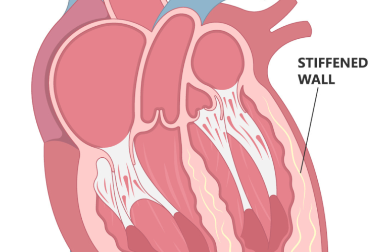 Cardiomyopathy