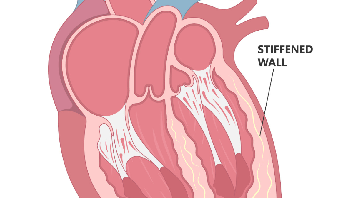 Cardiomyopathy