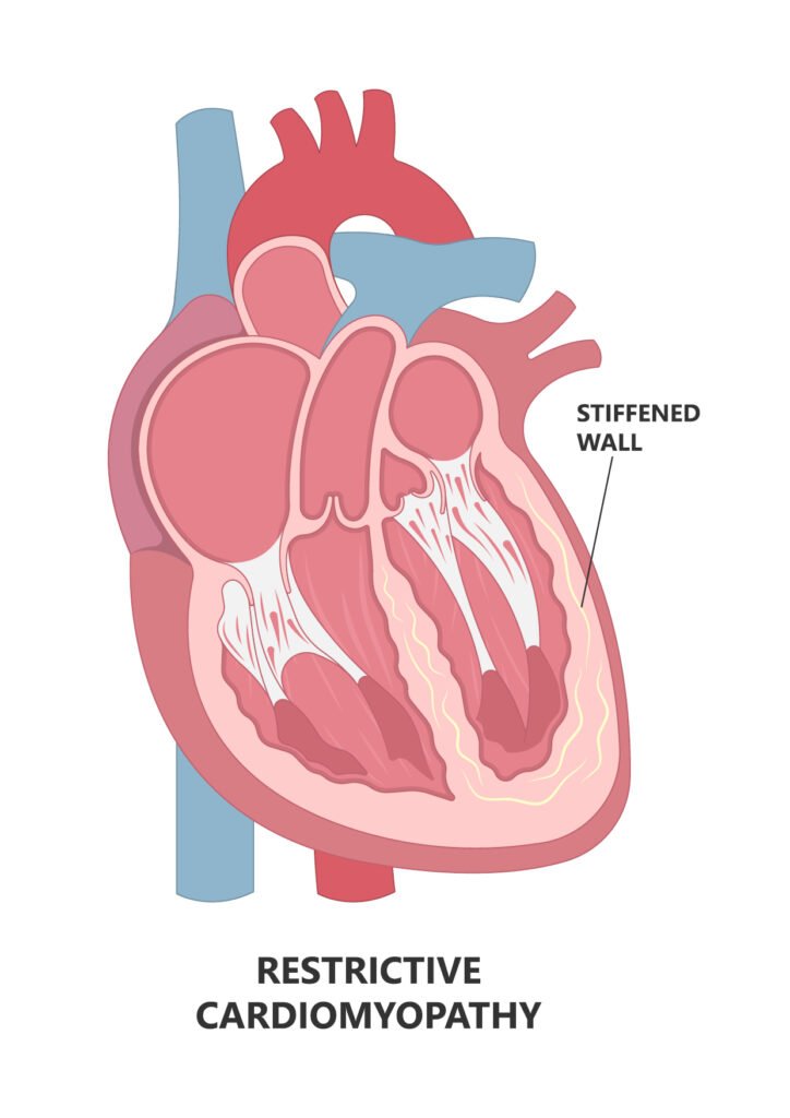 Restrictive Cardiomyopathy (RCM)
