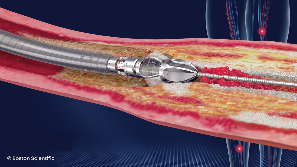 Jetstream atherectomy