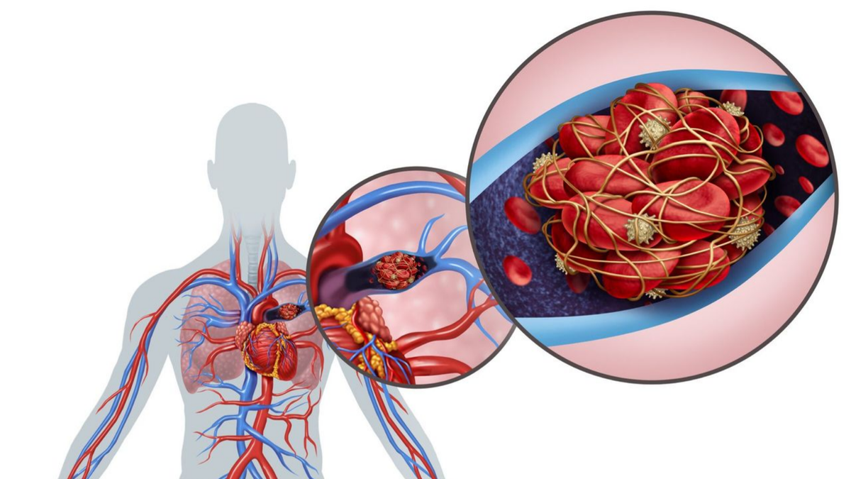 From Breathless to Better A Guide to Pulmonary Embolism and Recovery